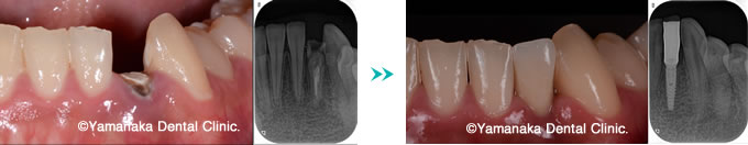 抜歯即時インプラント症例
